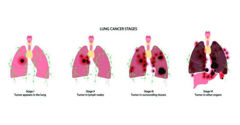 Stages Of Lung Cancer - Health365.sg