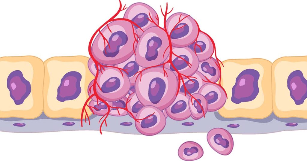 tumour-grading-vs-cancer-staging-health365-sg