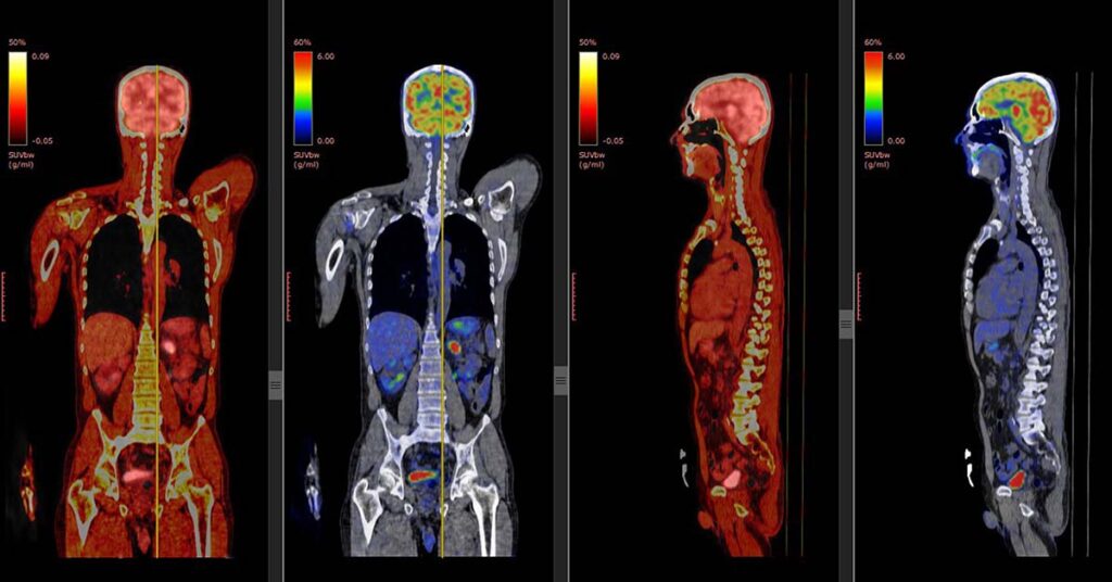 What Is A PET Scan And What Is It Used For? Health365.sg