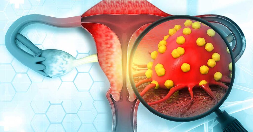 risk-of-ovarian-malignancy-algorithm-roma-for-assessing-likelihood-of