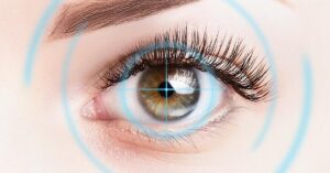 LASIK Eye Surgery