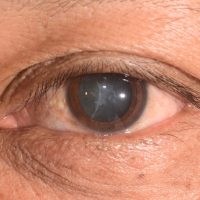 Cataract In Singapore, Cataract Surgery In Singapore