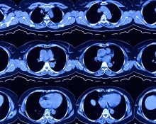 64 slice CT scan is it sufficient?