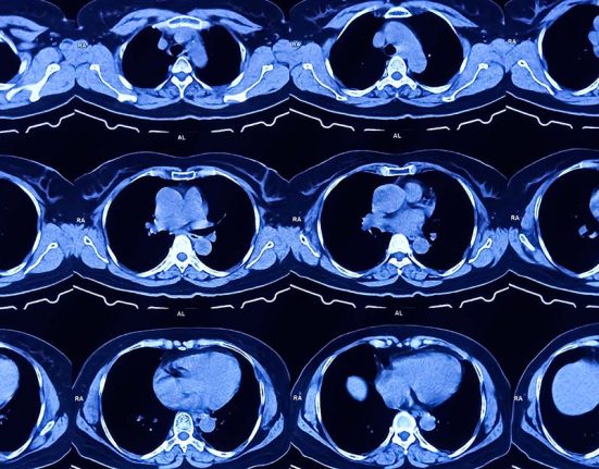 64 slice CT scan is it sufficient?