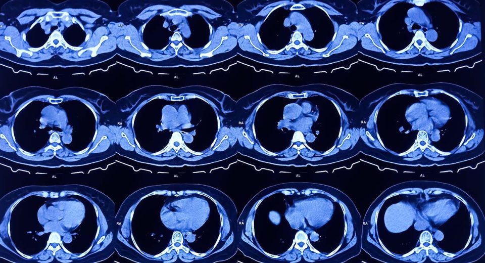 64 slice CT scan is it sufficient?