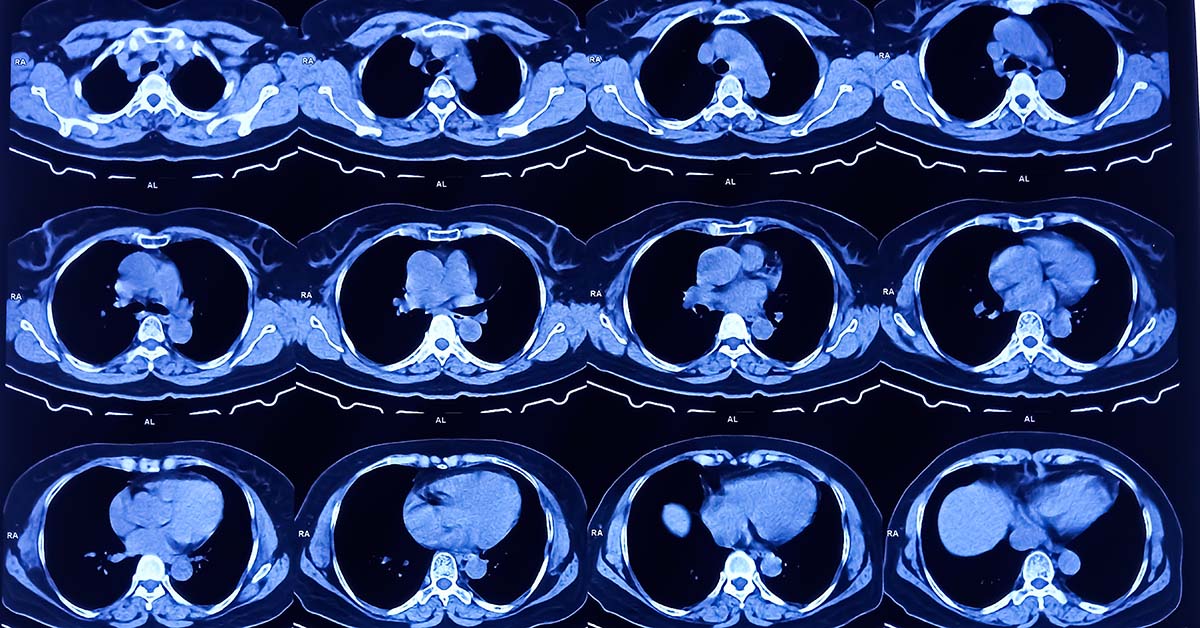 64 slice CT scan is it sufficient?