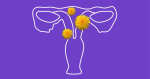 uterine fibroids image women's health gynecological conditions