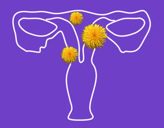 uterine fibroids image women's health gynecological conditions