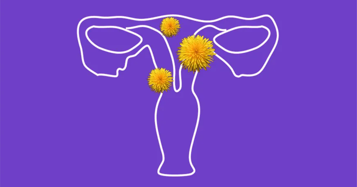 uterine fibroids image women's health gynecological conditions