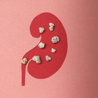 Kidney stones in Singapore