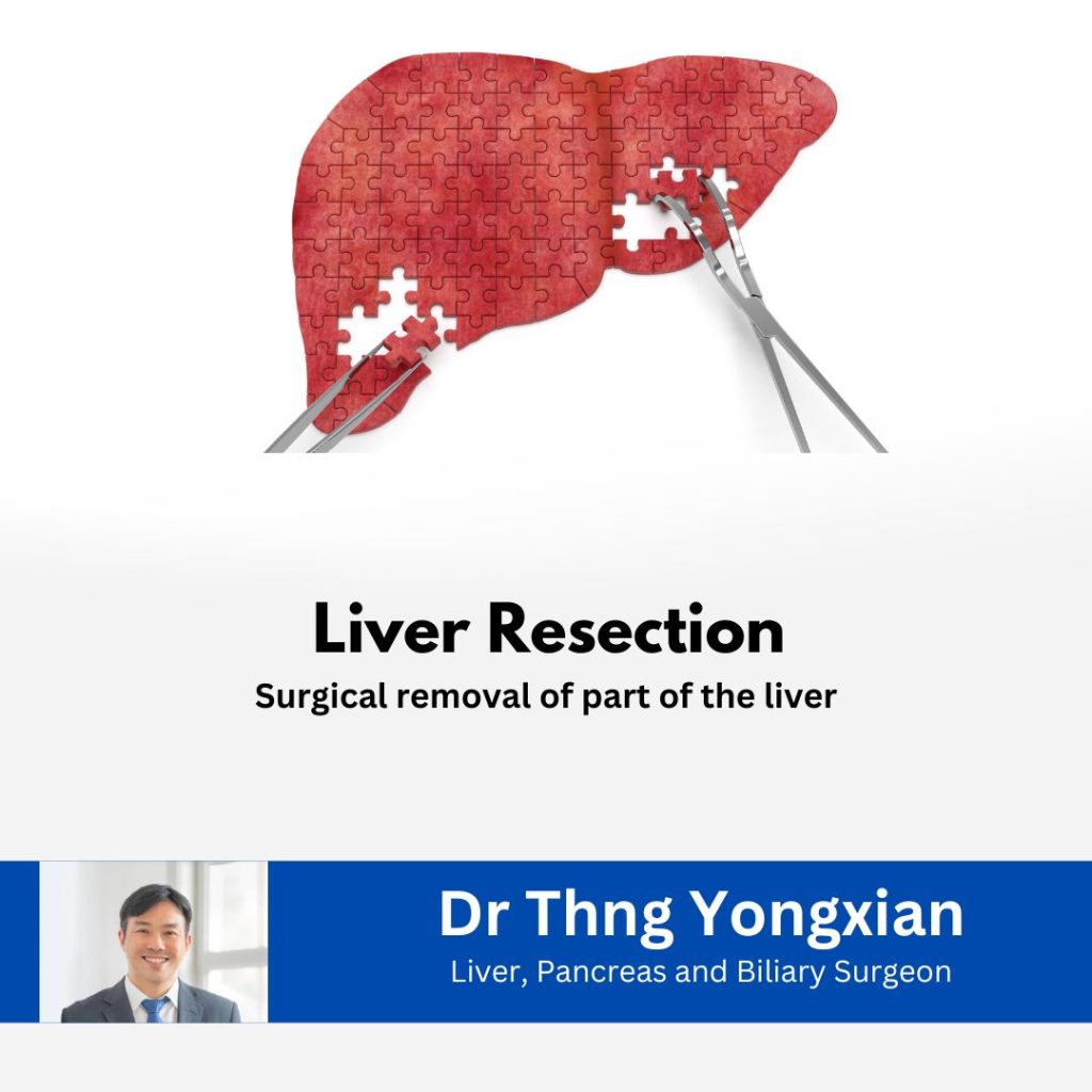 Dr Thng Yongxian liver resection