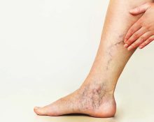 Varicose veins Singapore