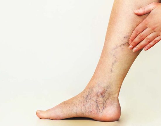 Varicose veins Singapore