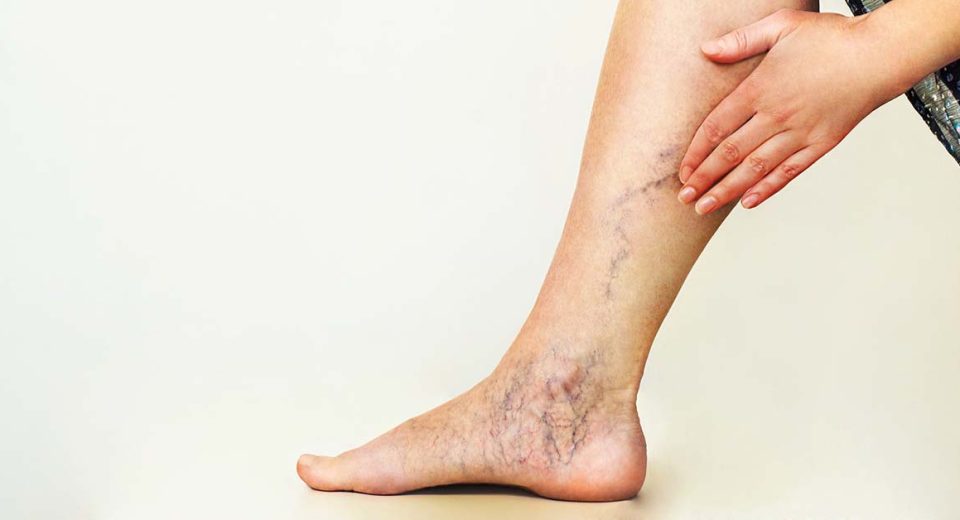 Varicose veins Singapore