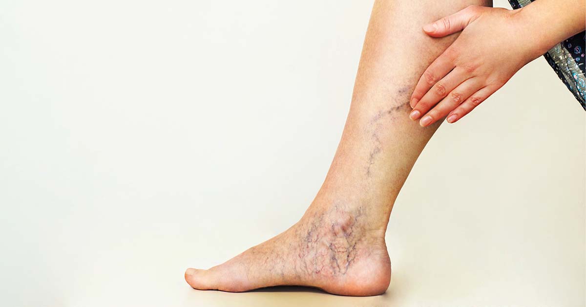 Varicose veins Singapore