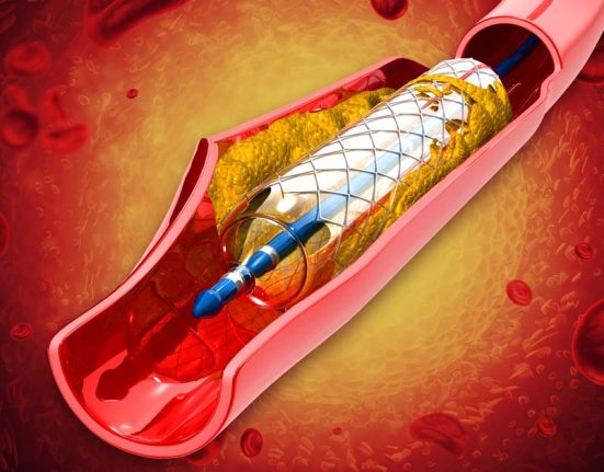 Coronary artery disease treatment options