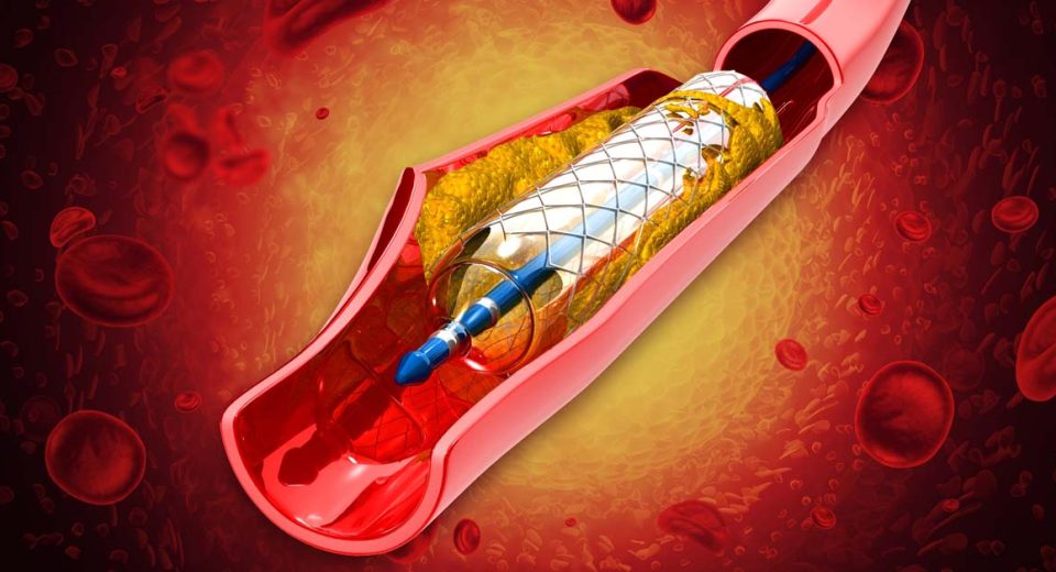 Coronary artery disease treatment options