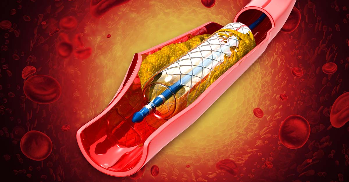 Coronary artery disease treatment options