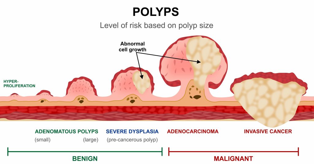 From Polyps To Cancer