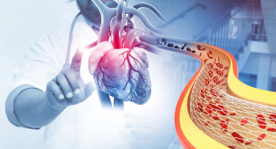 Stent or bypass