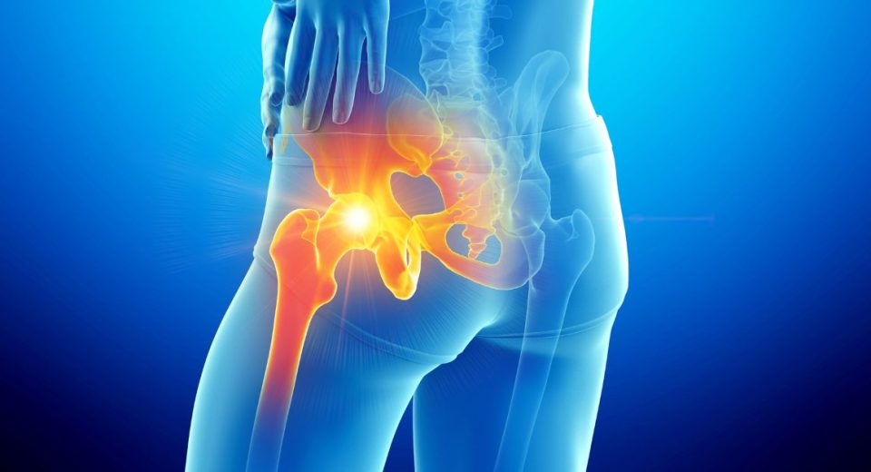 best hip replacement for athletes​