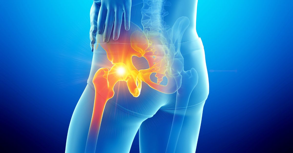 best hip replacement for athletes​