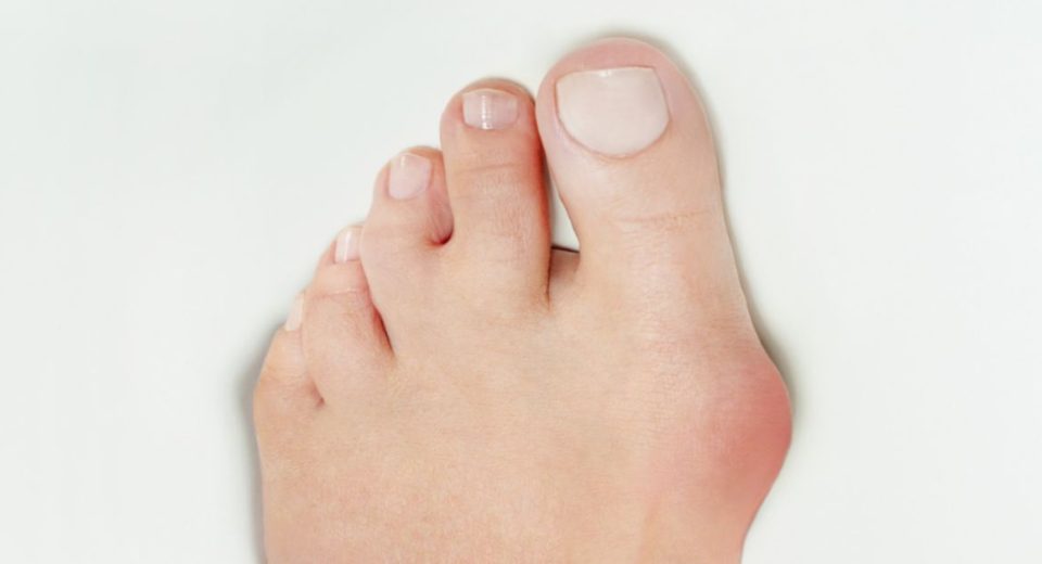 bunion surgery