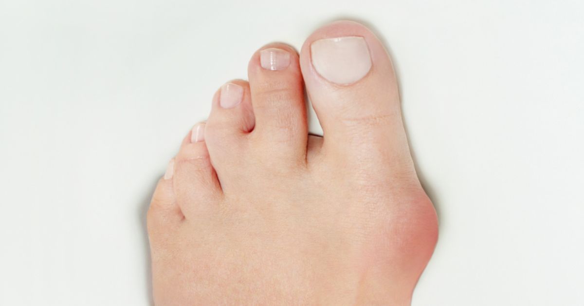 bunion surgery