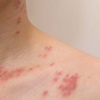 Vaccination for Shingles