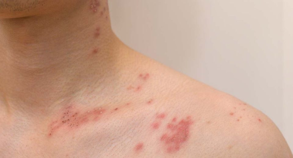 Vaccination for Shingles