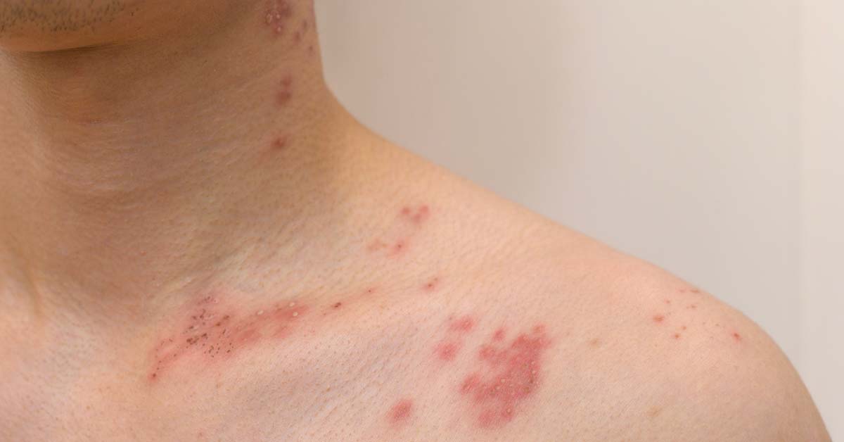 Vaccination for Shingles